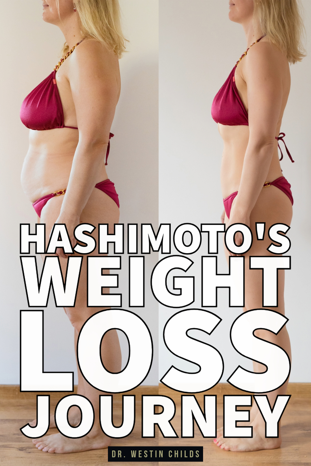 Hashimoto's weight loss journey Hashimoto's weight loss journey