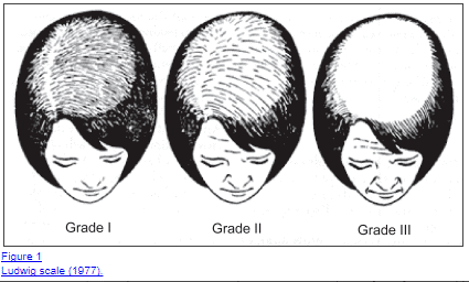 male pattern baldness male pattern baldness in women