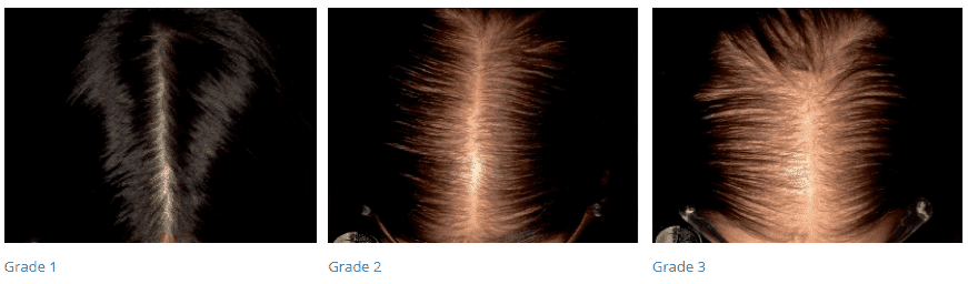 female pattern hair loss in women female pattern hair loss in women