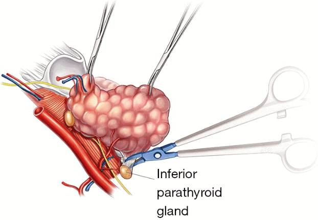 picture of the parathyroid gland in relationship to the thyroid gland picture of the parathyroid gland in relationship to the thyroid gland