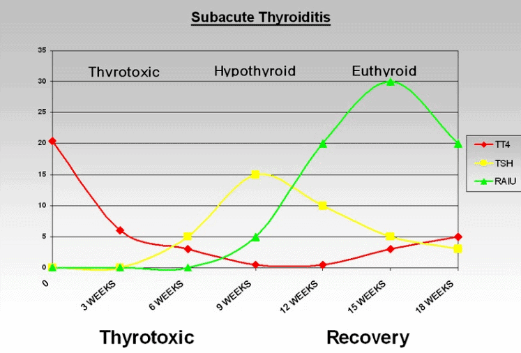 thyroid lab tests overtime with subacute thyroiditis thyroid lab tests overtime with subacute thyroiditis