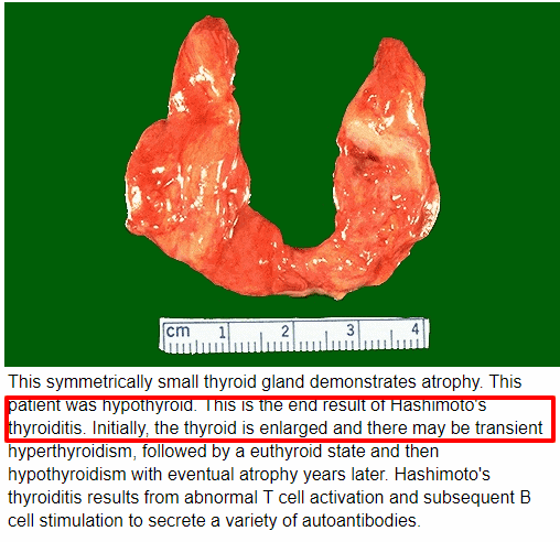 end stage hashimoto's causes destruction of the thyroid gland end stage hashimoto's causes destruction of the thyroid gland