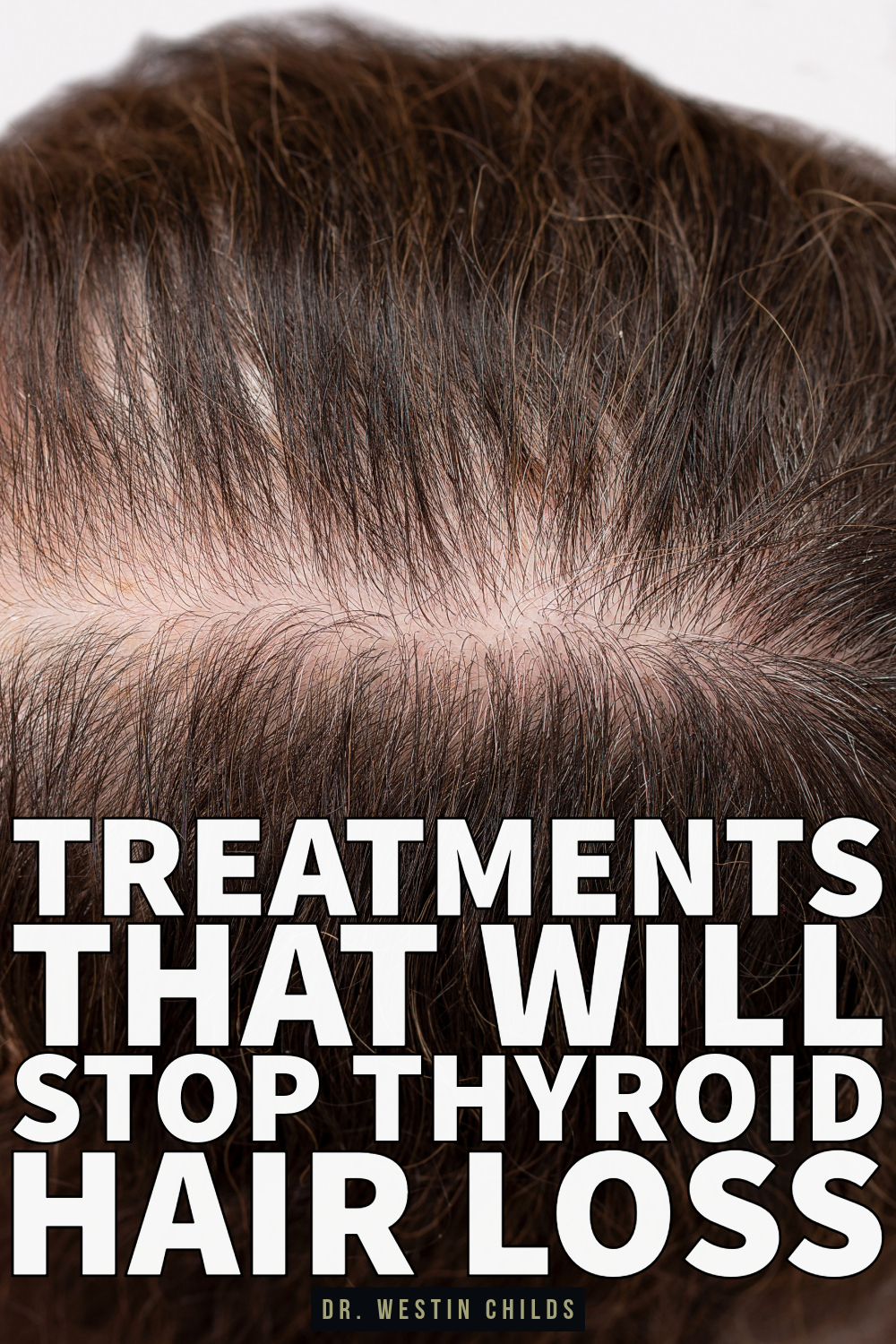 treatments that will stop thyroid hair loss treatments that will stop thyroid hair loss