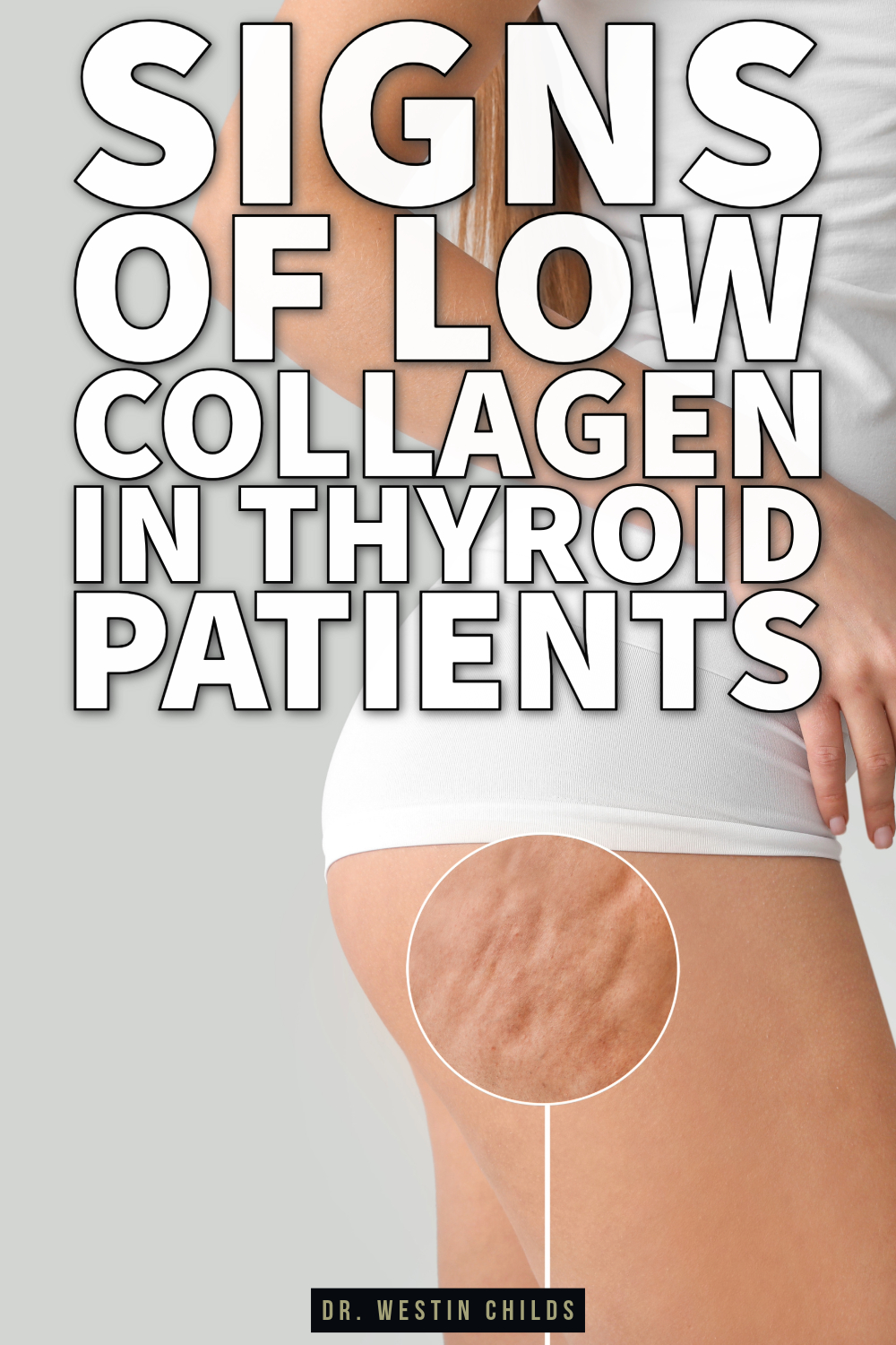 low collagen in thyroid patients (1) low collagen in thyroid patients