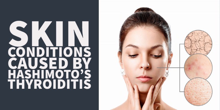 15 Skin Conditions Caused By Hashimoto's Thyroiditis