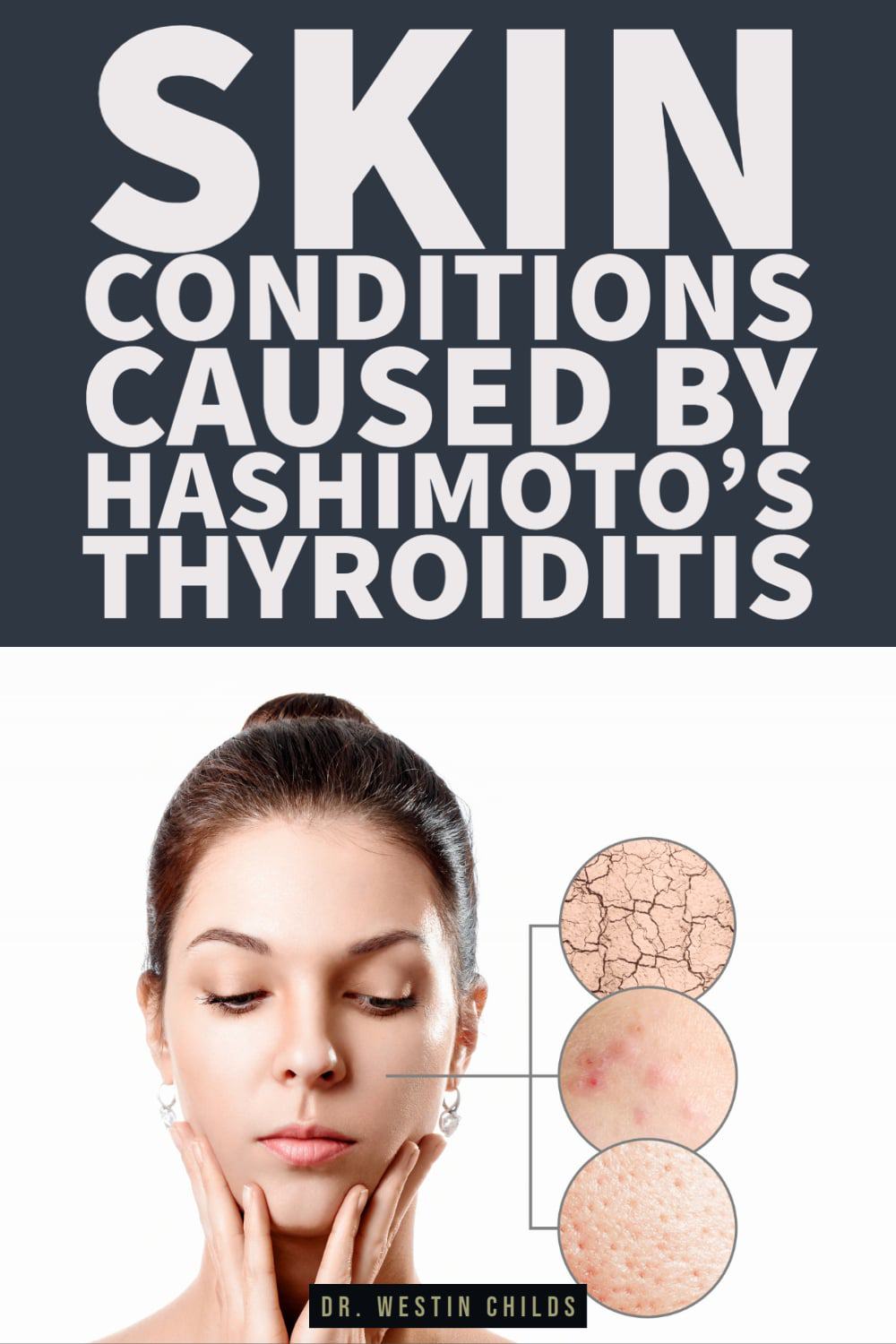 these skin conditions are caused by hashimoto's thyroiditis these skin conditions are caused by hashimoto's thyroiditis