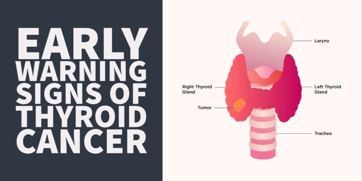 Thyroid cancer symptoms and early warning signs