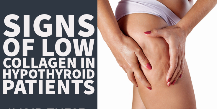 Signs of Low Collagen In Hypothyroid Patients